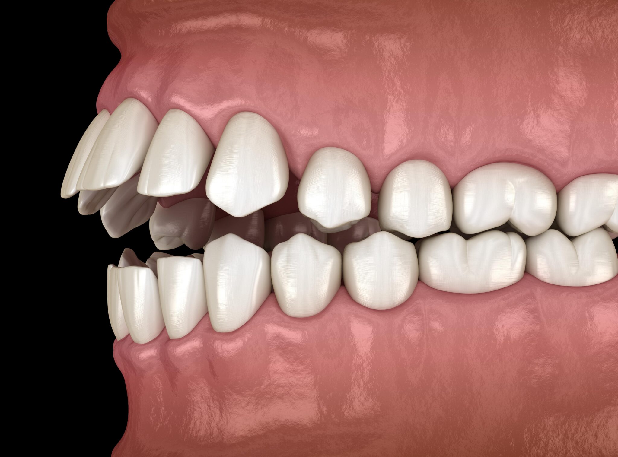 Arcada dentária torta: entenda as implicações e possíveis problemas Blog - OrthoDontic Sorria Sempre