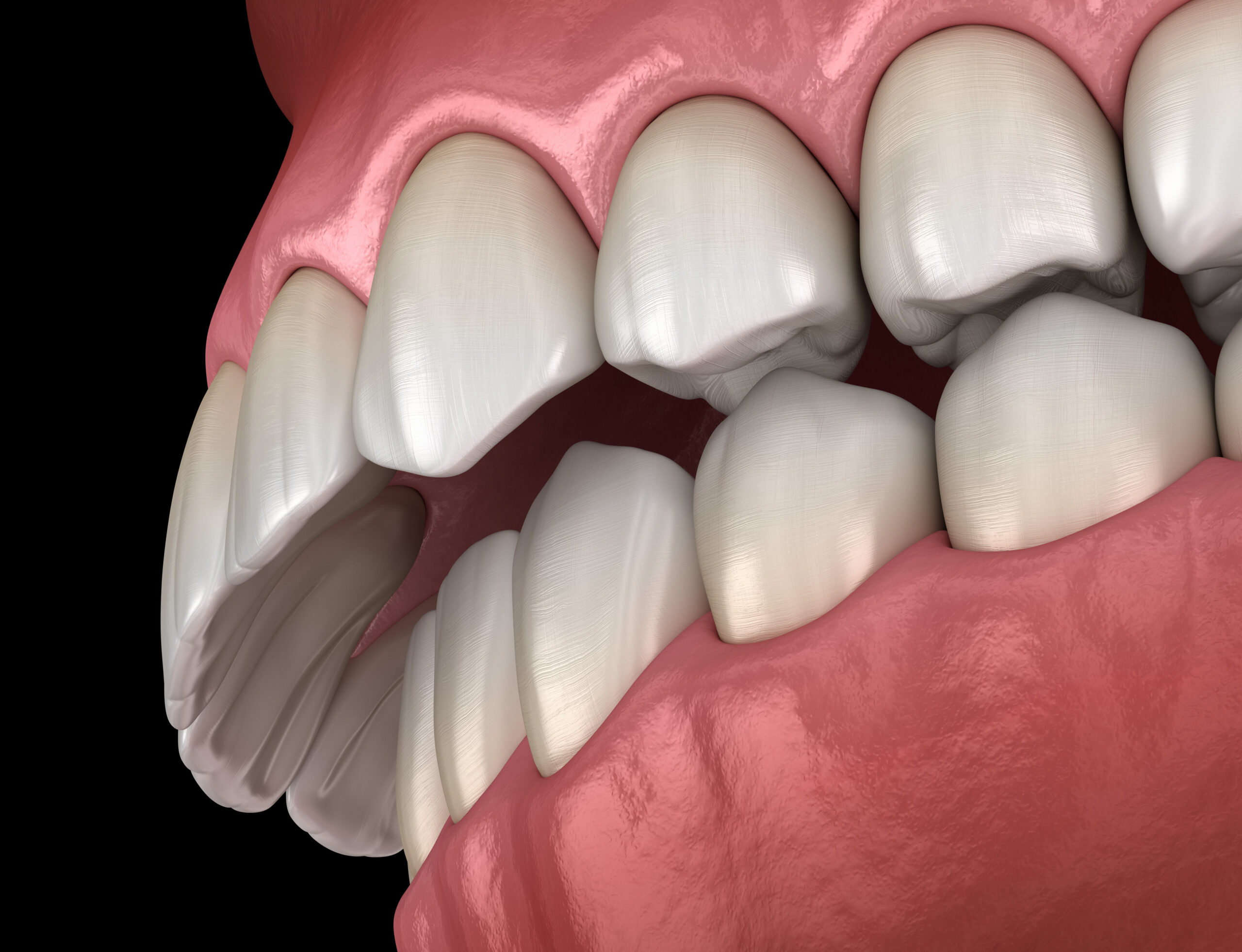 Oclusão dentária entenda o que é e quando pode acarretar problemas
