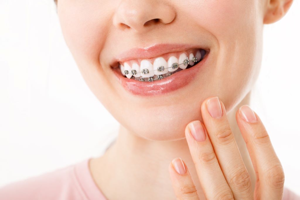 Na imagem, uma mulher sorrindo, com aparelhos ortodonticos nos dentes e a sua mão está próxima a seu queixo.