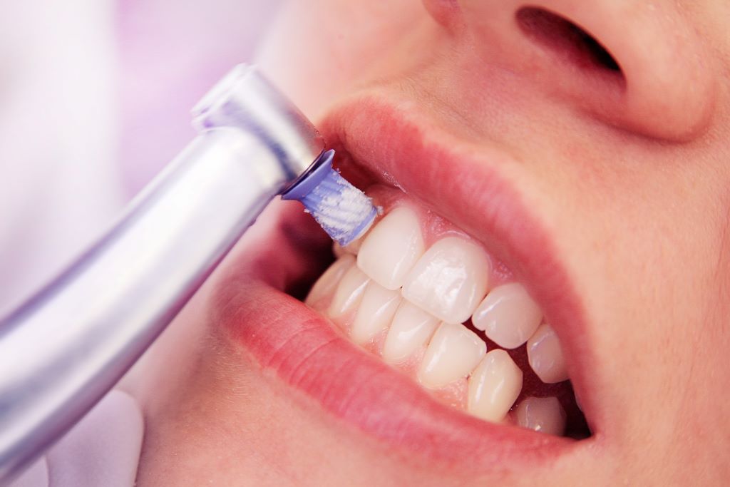 na imagem, uma mulher com os dentes expostos e um aparelho de dentista enconstando neles, o aparelho é de realizar a profilaxia dental.