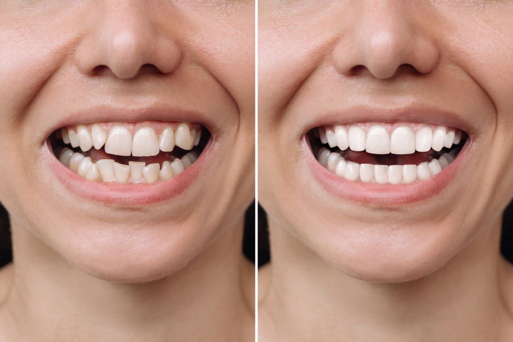 Na foto, há uma pessoa com um sorriso torto e ao lado uma foto do mesmo sorriso com os dentes alinhados.