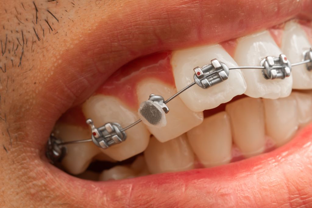 Na foto, dentes c om aparelho e uma das peças do aparelho está quebrada.