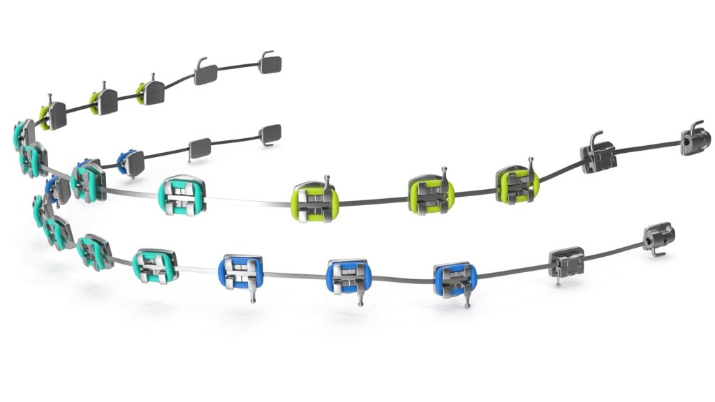 Aparelho Tradicional 6 Tradicional