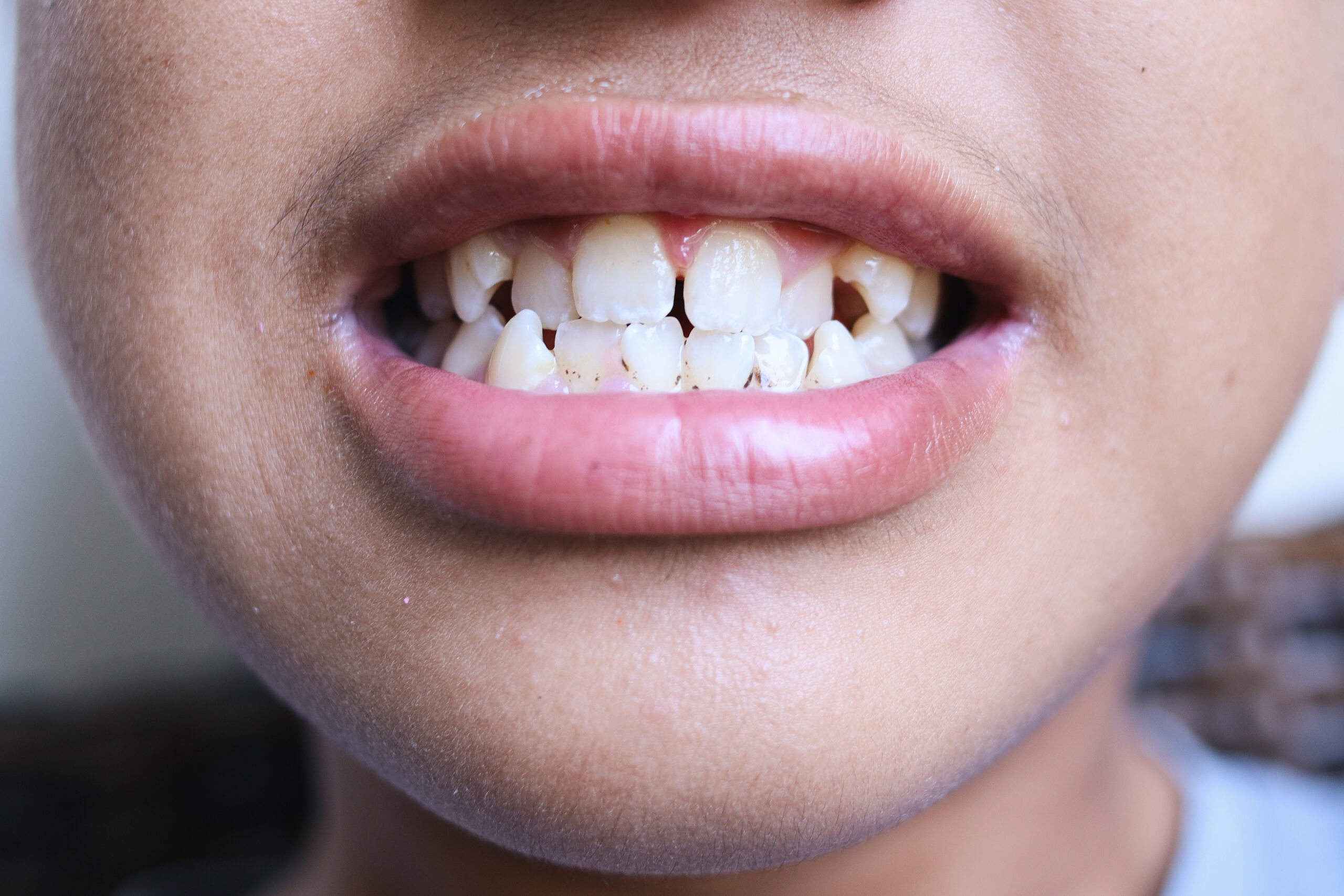 Dentes desalinhados antes do tratamento ortodôntico.