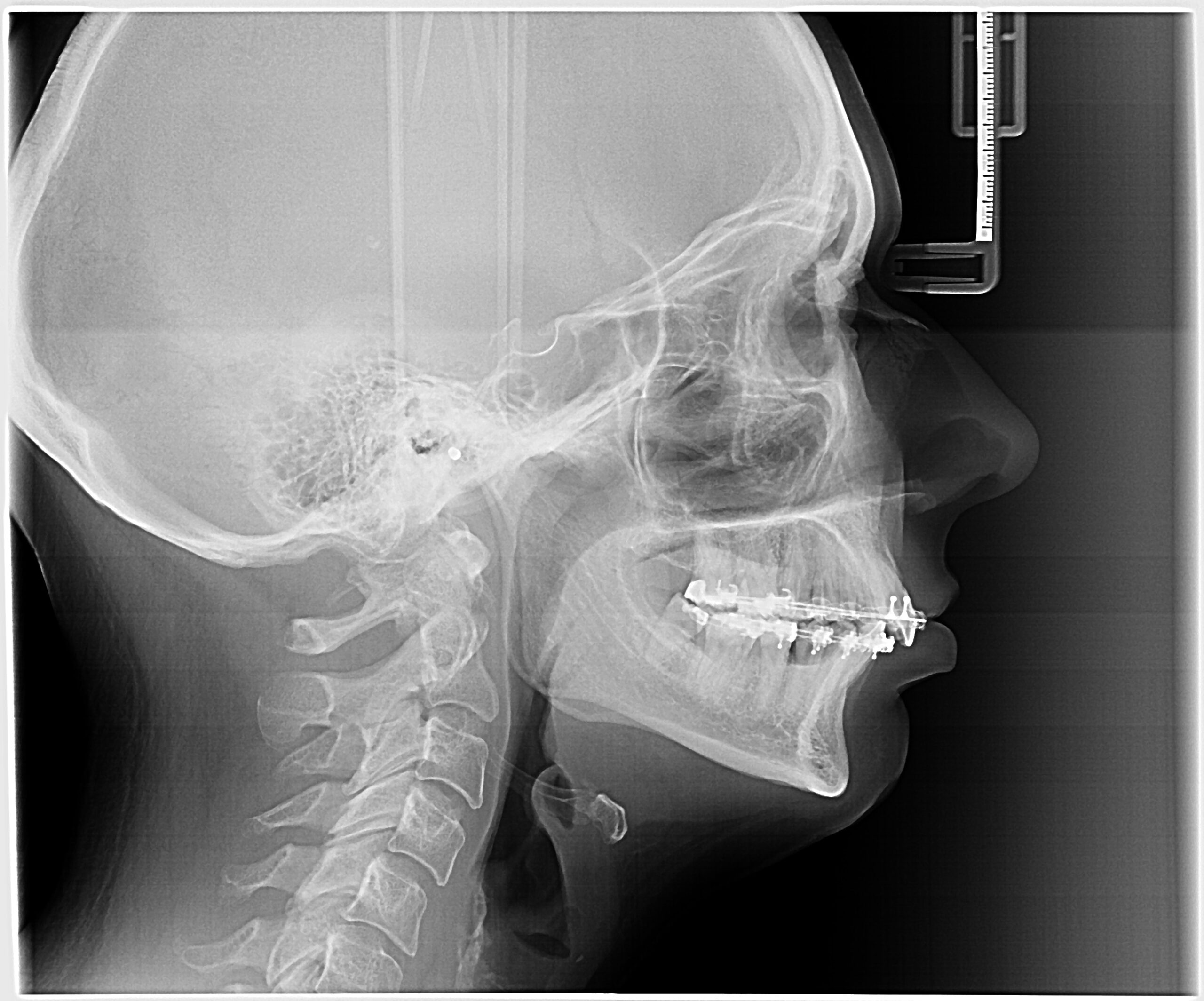cirurgia ortognática